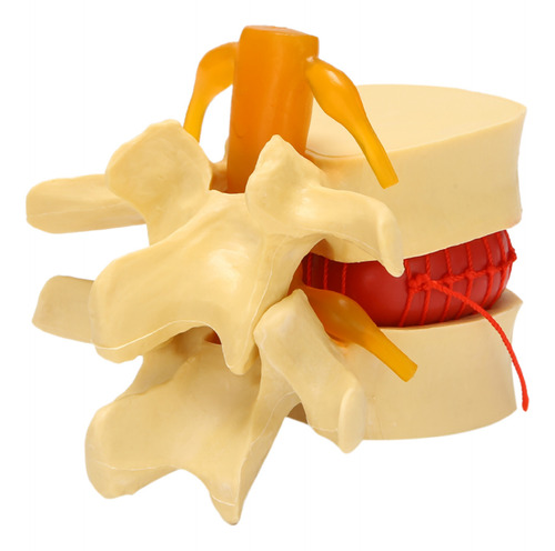 Modelo De Vértebras Lumbares: Hernia Anatómica De Disco Lumb