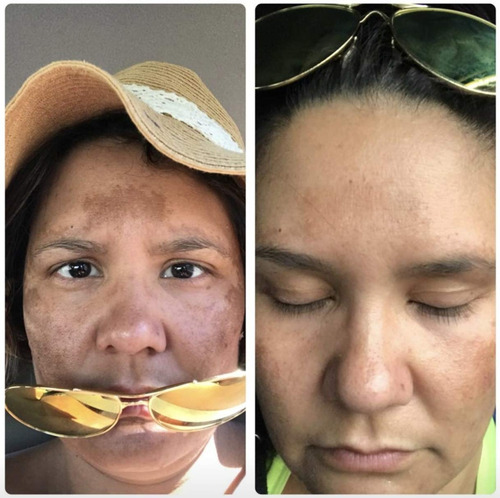 Admire My Skin 2 % Hydroquinone Remove - mL a $5000