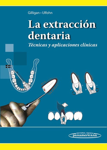 Ulfohn - La Extracción Dentaria