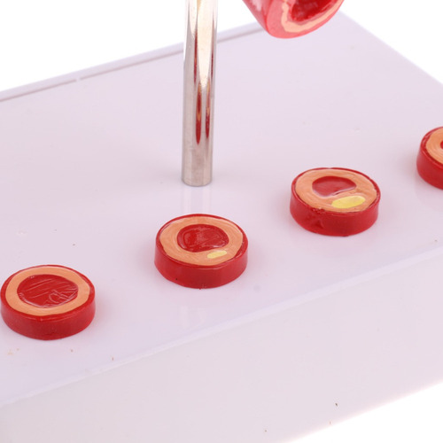 Modelo De Vascular De Trombo De Aterosclerosis De Vaso