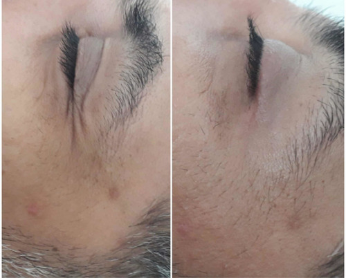 Imagen 2 de 4 de Hifu 7d Ultrasonido Focalizado - Lifting Sin Cirugía