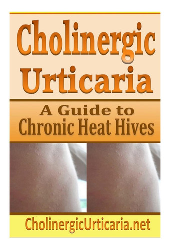 Libro: Cholinergic Urticaria: A Guide To Chronic Heat Hives