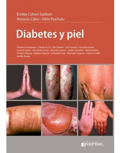 Diabetes Y Piel - Sabban Cohen