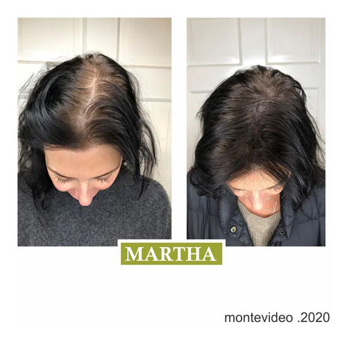 Kit Anticaída Biotin-plextm Caída Del Cabello