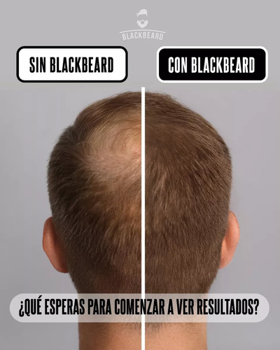 Minoxidil Al 10% Blackbeard Adicionado Con Cafeina 1 Mes