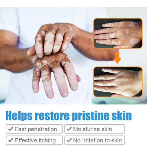 Crema China Para Tratar Vitiligo