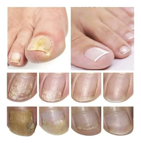 32 Parches Reparacion Uñas Nail Hongos Extracto De Hierbas