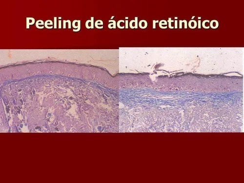 1 Grama Ácido Retinoico Tretinoina 100% Pura (pó)