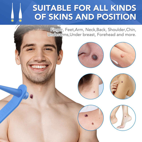 Micro Skin Tag Remover Kit De Eliminación De Etiquetas
