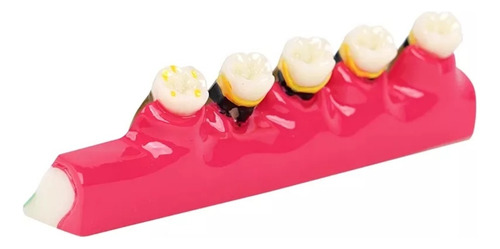 Manequim Modelo Odontológico Cárie Dente - C3