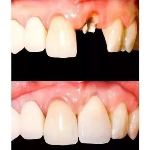 Snap On Smile Dentes ( R E S I N A ) Repõe 1 Dente Ausente
