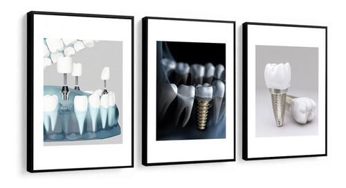 Quadro Odontologia Implante Dentista Consultório Com Moldura