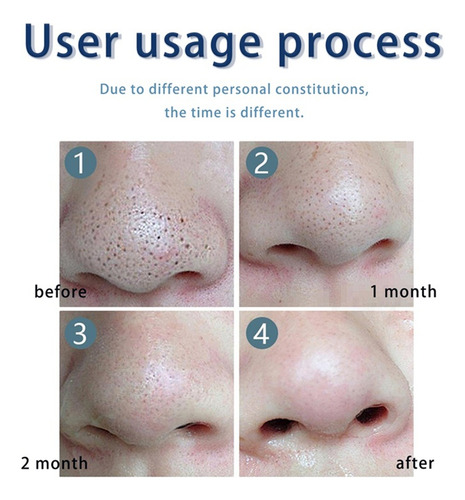 Loción Secante J Pimple De 30 Ml I Con Loción De Óxido I Par
