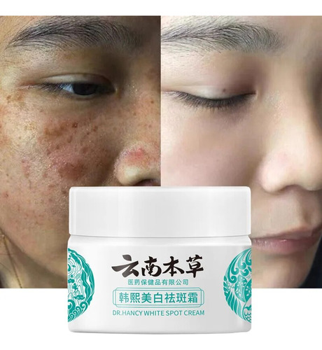 Potente Crema Blanqueadora Para Eliminar Pecas Con Hierbas D