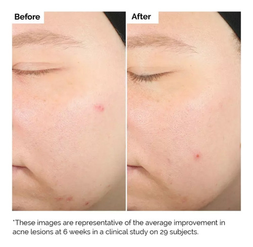 The Ordinary Salicylic Acid 2% Solution 30ml