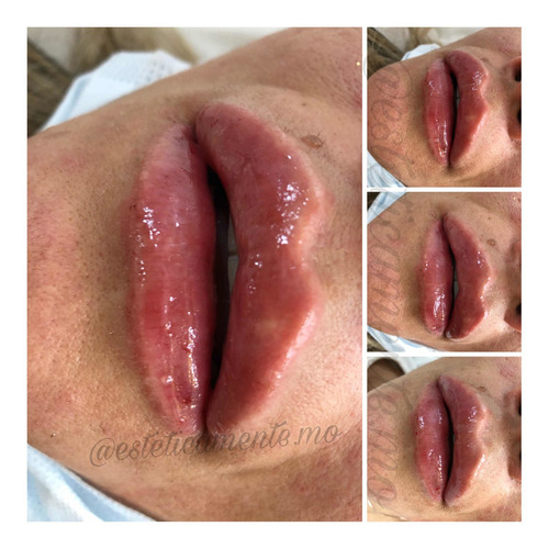 Imagen 2 de 5 de Relleno De Labios