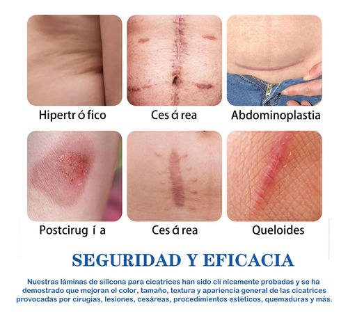 Parches De Silicona Para Cicatricescinta De Silicona