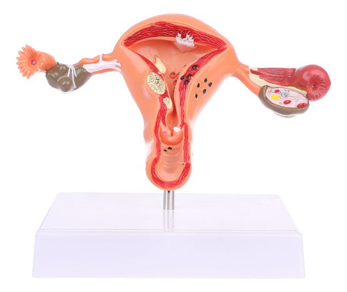 W Modelo Anatómico Patológico Del Útero, Ovario, Anatomía Q