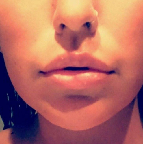 Imagen 2 de 3 de Relleno De Labios Con Acido Hialurónico Reticulado