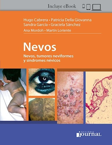 Cabrera Nevos, Tumores Neviformes Y Síndromes Névicos Nu 