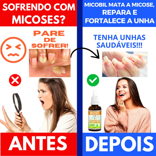 Micose Entre Os Dedos Do Pé Antimicótica Micose Unha Fungos
