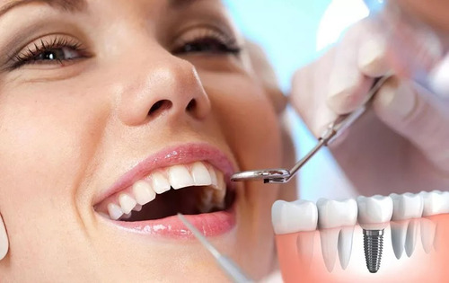 Implantes Dentales. Montevideo, San Jacinto Canelones
