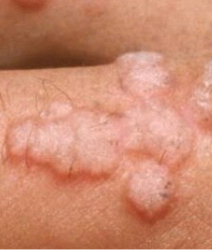 hpv dry skin