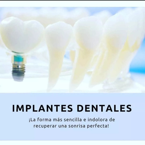 Implantes Dentales. Montevideo, San Jacinto Canelones