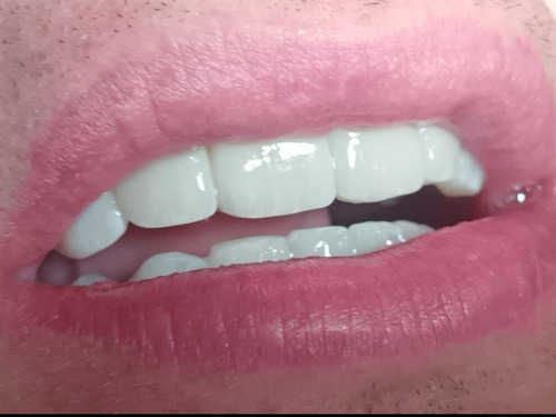 Carillas Dentales De Zirconio