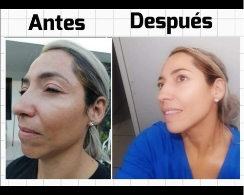 Crema Aclarante Facial Y Corporal, Md Aesthetics, Quita Paño