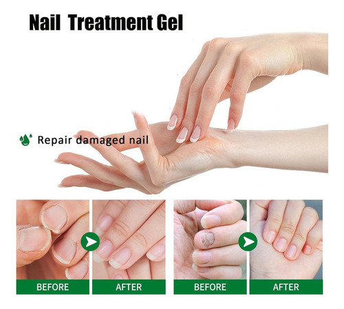 - Gel De Tratamiento De Uñas Nutraboost, Crema De Uñas