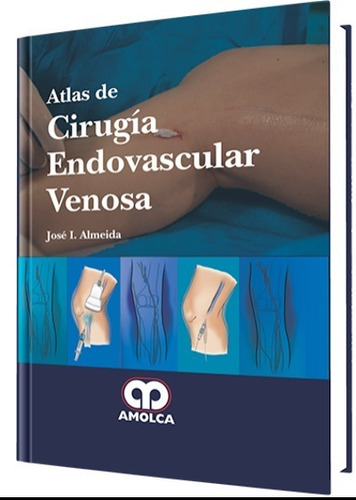 Atlas De Cirugía Endovascular Venosa Almeida Amolca