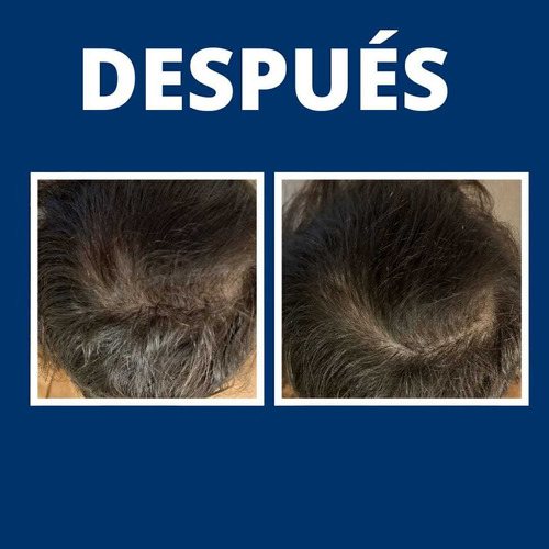 Imagen 3 de 5 de Mesoterapia Capilar