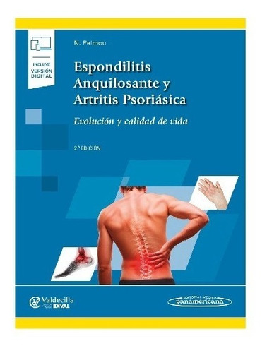 Espondilitis Anquilosante !