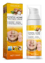 Comprar Creme Para Tratamento Da Acne: Combate A Acne Hormonal Císti