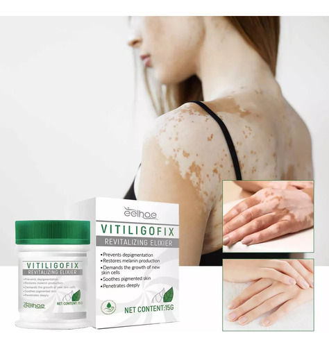 . Pomada Blanca Para El Vitíligo, Crema Para La Micosis, Leu