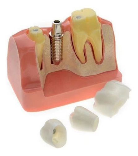 Modelo De Dientes De Implantes Dentales De 4 Veces