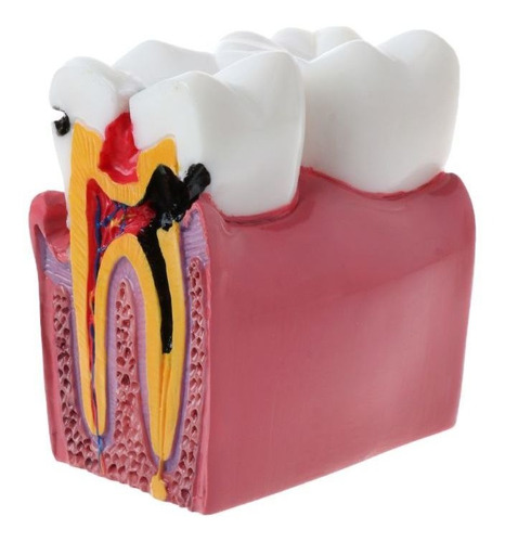 Modelo De Dientes De Anatomía De Comparación De Caries Denta