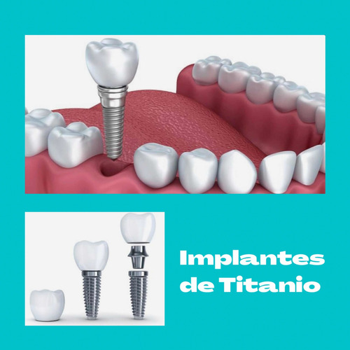 Imagen 4 de 4 de Implantes Dentales, Odontología , Consulta Sin Cargo