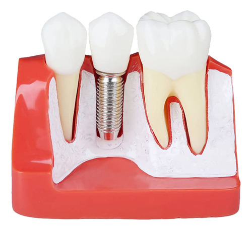 Modelo De Demostración De Dientes: Implante, Análisis Removi