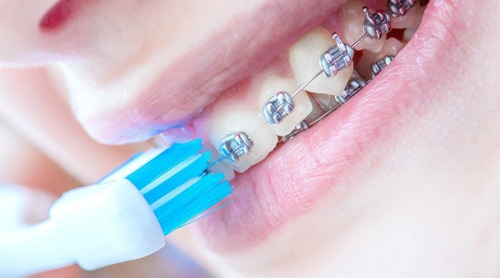  Cepillo Dental Ortodoncia Oral B Original Consulte Precio 
