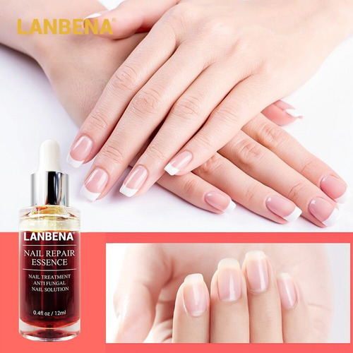 Tratamento De Unhas Fungo Remove Onicomicose Dedo Do Pé 15ml