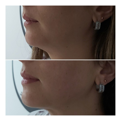 Imagen 3 de 4 de Hifu 8d Facial