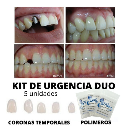 Kit Dentadura Perno Corona Postiza Cosmética Agnovedades 