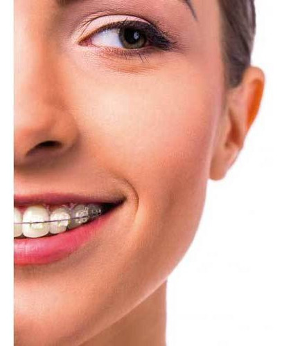 Imagen 4 de 10 de Tratamiento Ortodoncia - Brackets Porcelana Esteticos