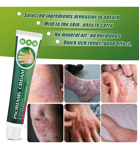 Mz D Crema Dermatofito Psoriasis Crema Dermatofito Tópica