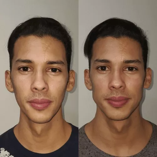 Exercício Para O Rosto Harmonização Facial Mewing Resultados em