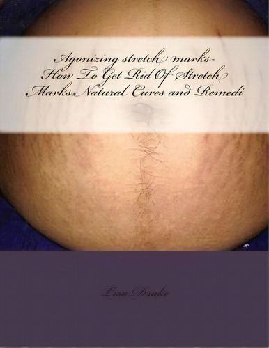 Agonizing Stretch Marks-how To Get Rid Of Stretch Marks, De Lisa Drake. Editorial Createspace Independent Publishing Platform, Tapa Blanda En Inglés