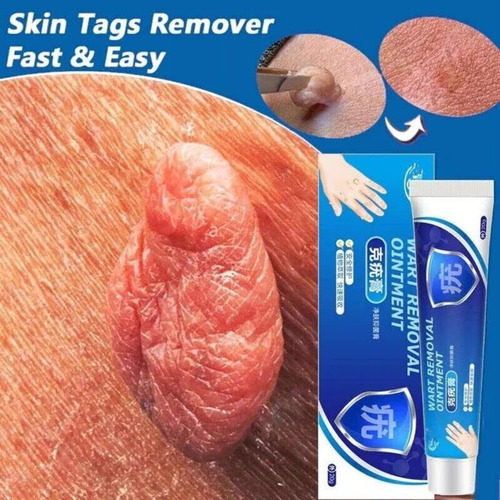 A Crema De Removedor Corporal Eliminador De Verrugas *4.