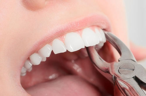 Extraccion Dentaria Compleja Odontologia